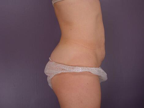 Liposuction Before & After Image