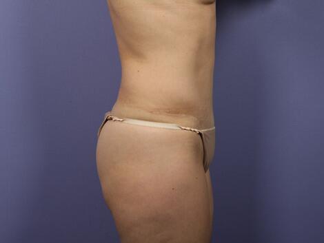 Liposuction Before & After Image