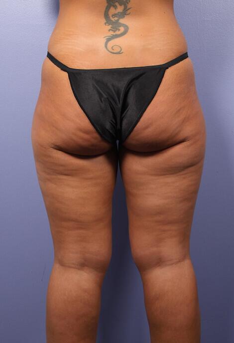 Liposuction Before & After Image