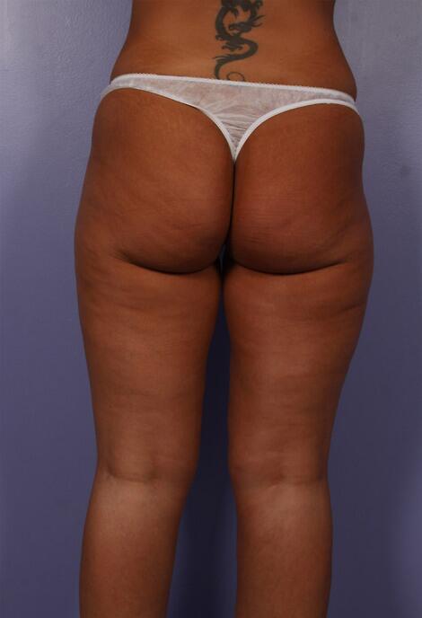 Liposuction Before & After Image