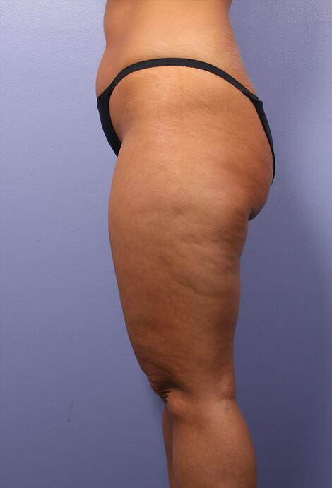 Liposuction Before & After Image