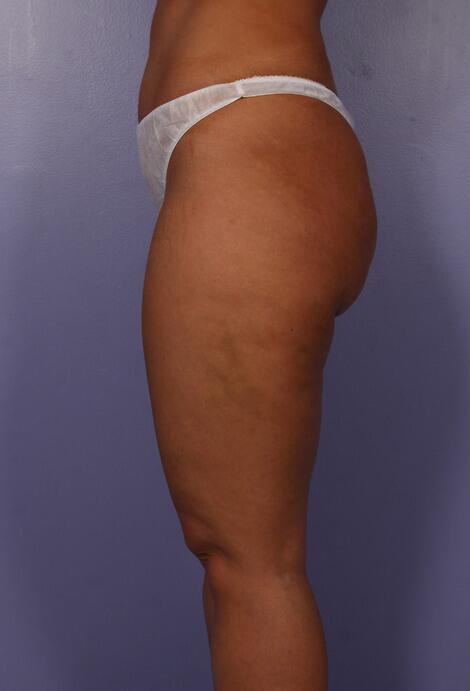 Liposuction Before & After Image