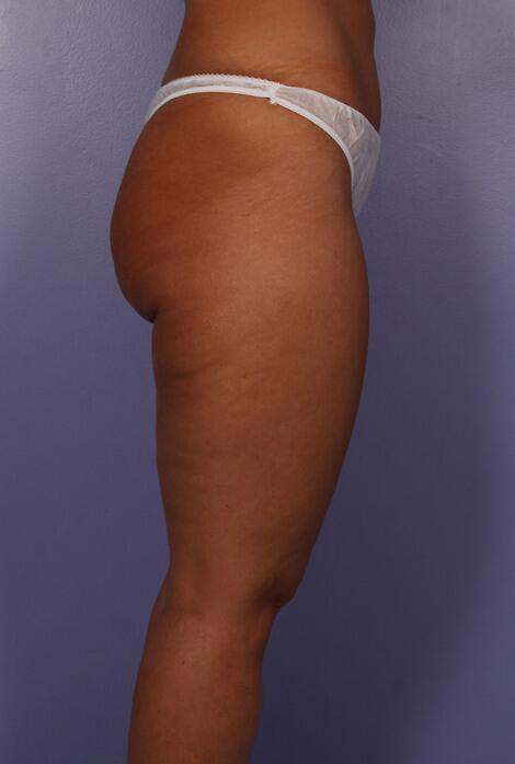 Liposuction Before & After Image