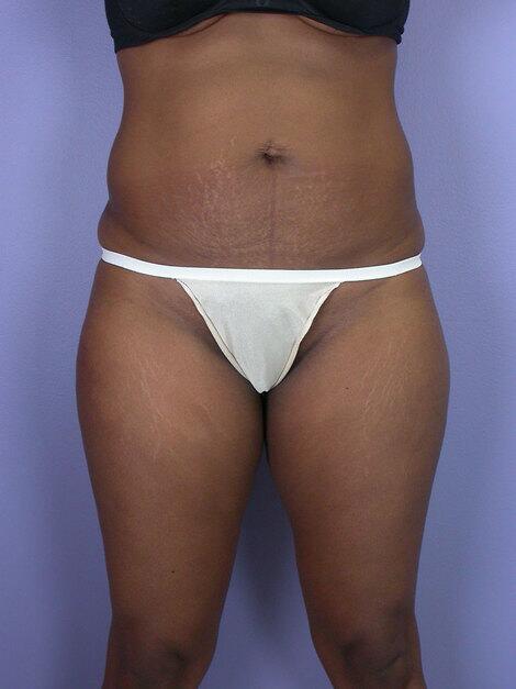 Liposuction Before & After Image