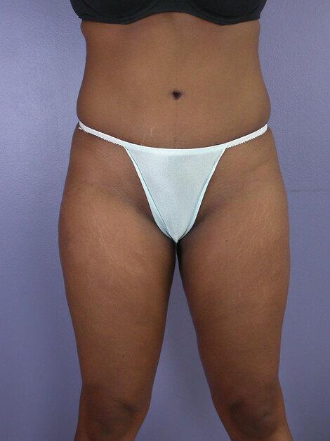 Liposuction Before & After Image