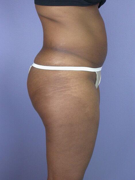 Liposuction Before & After Image