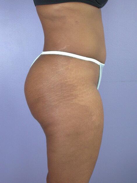 Liposuction Before & After Image