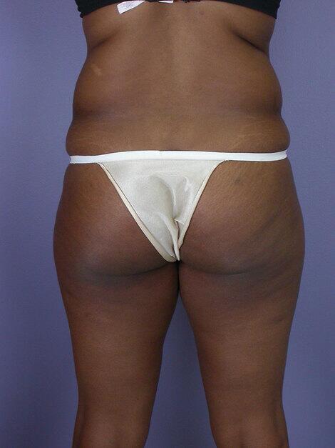 Liposuction Before & After Image