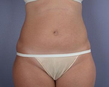 Liposuction Before & After Image