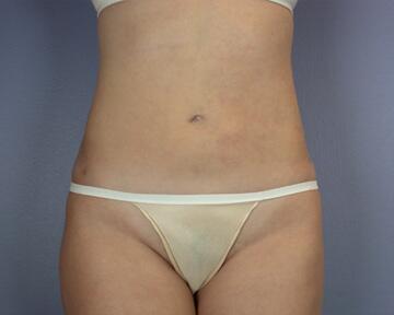 Liposuction Before & After Image