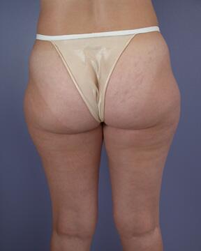 Liposuction Before & After Image