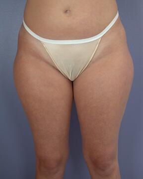 Liposuction Before & After Image