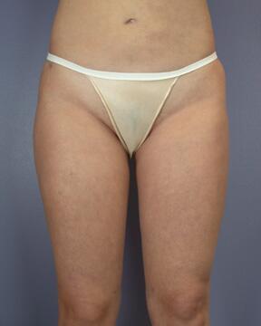 Liposuction Before & After Image