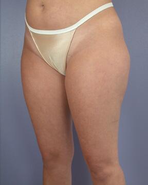 Liposuction Before & After Image