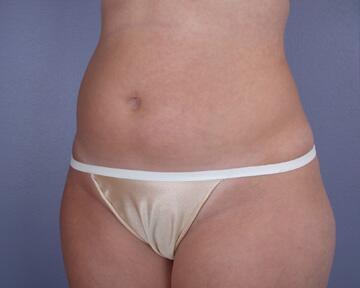 Liposuction Before & After Image