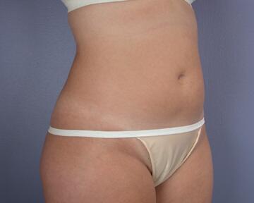 Liposuction Before & After Image