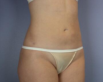 Liposuction Before & After Image