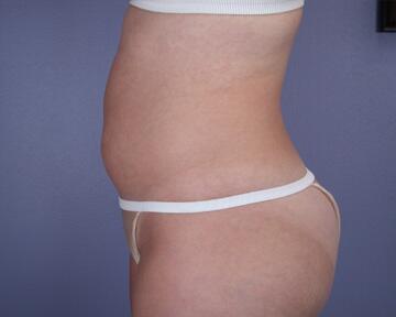 Liposuction Before & After Image