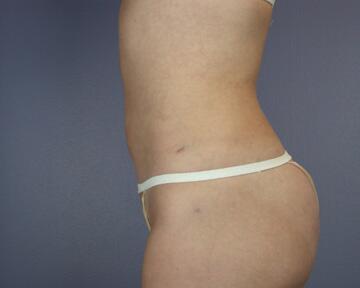 Liposuction Before & After Image