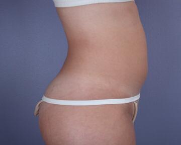 Liposuction Before & After Image