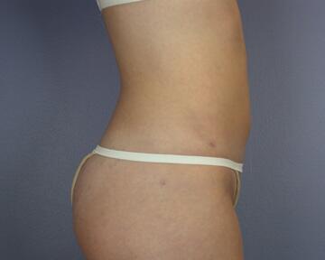 Liposuction Before & After Image