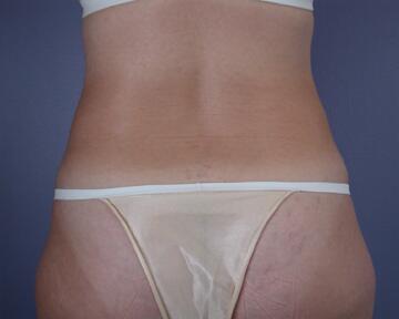 Liposuction Before & After Image