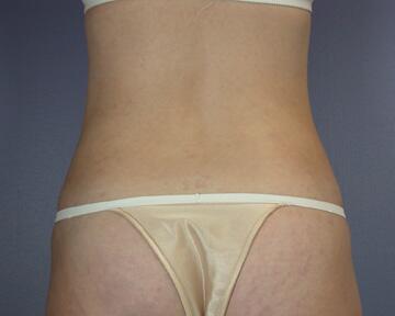 Liposuction Before & After Image