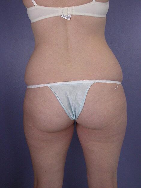 Liposuction Before & After Image