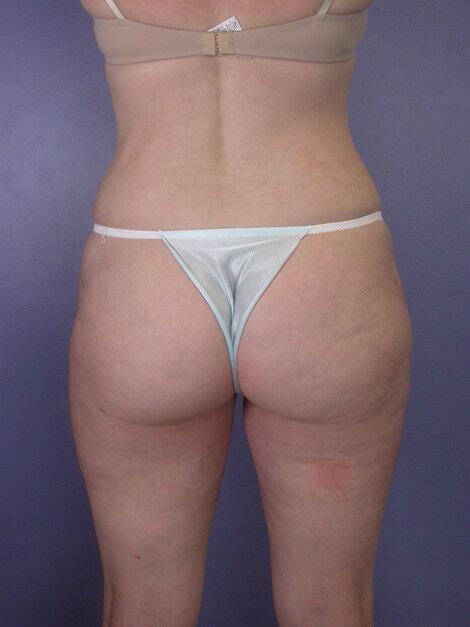 Liposuction Before & After Image