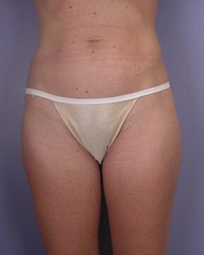 Liposuction Before & After Image