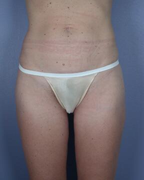 Liposuction Before & After Image