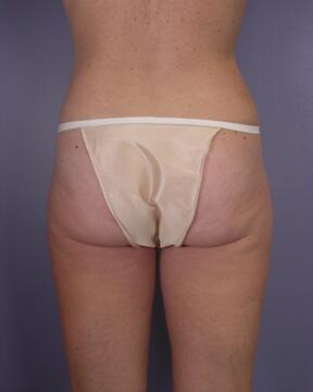 Liposuction Before & After Image