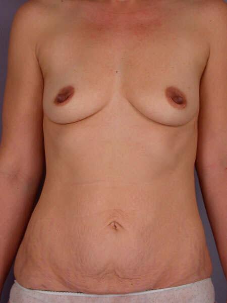 Liposuction Before & After Image