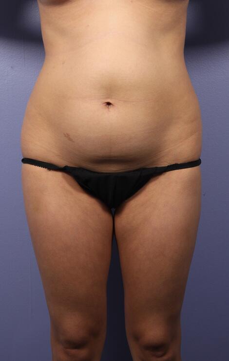 Liposuction Before & After Image