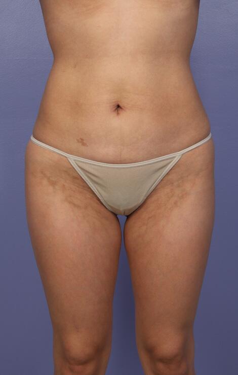 Liposuction Before & After Image