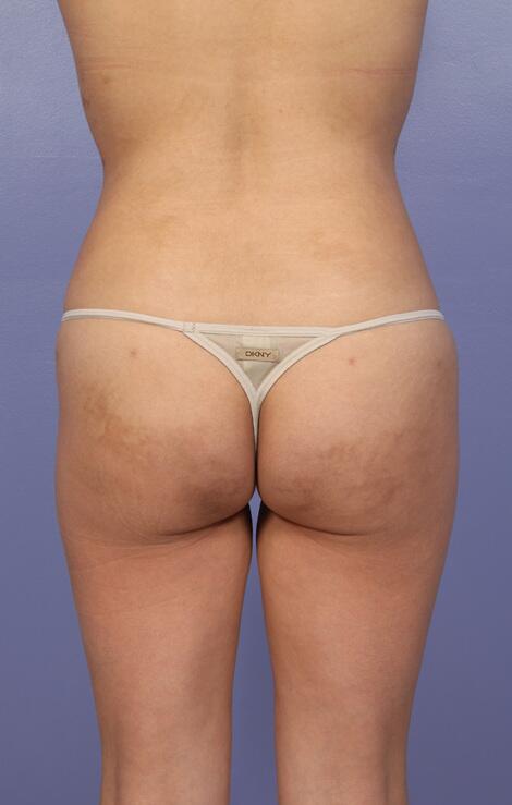 Liposuction Before & After Image