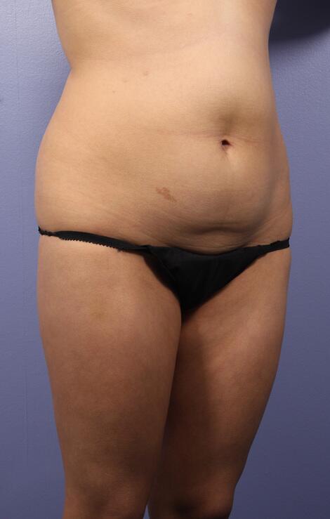 Liposuction Before & After Image