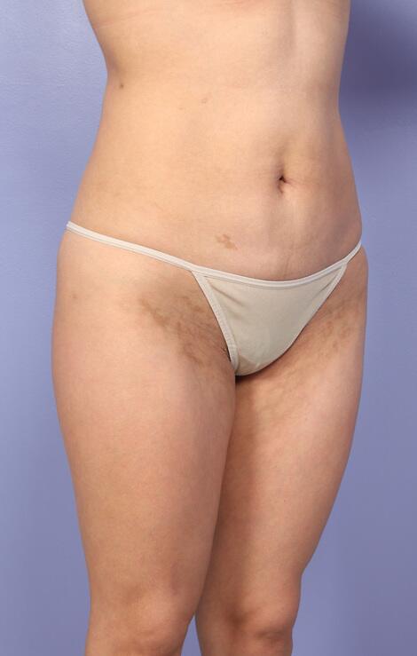 Liposuction Before & After Image