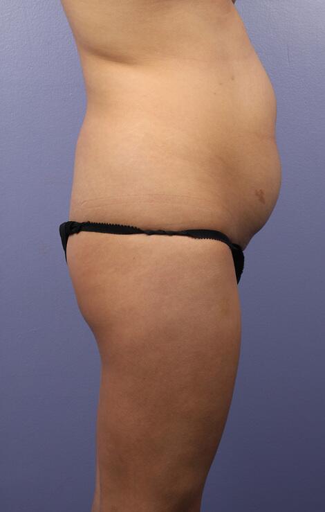 Liposuction Before & After Image