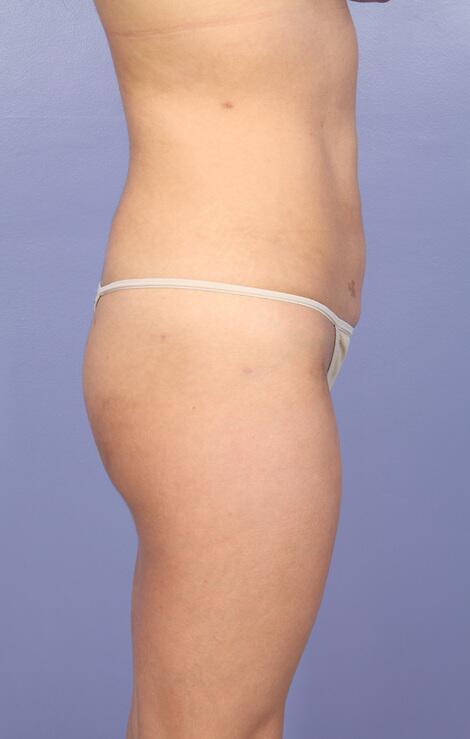 Liposuction Before & After Image