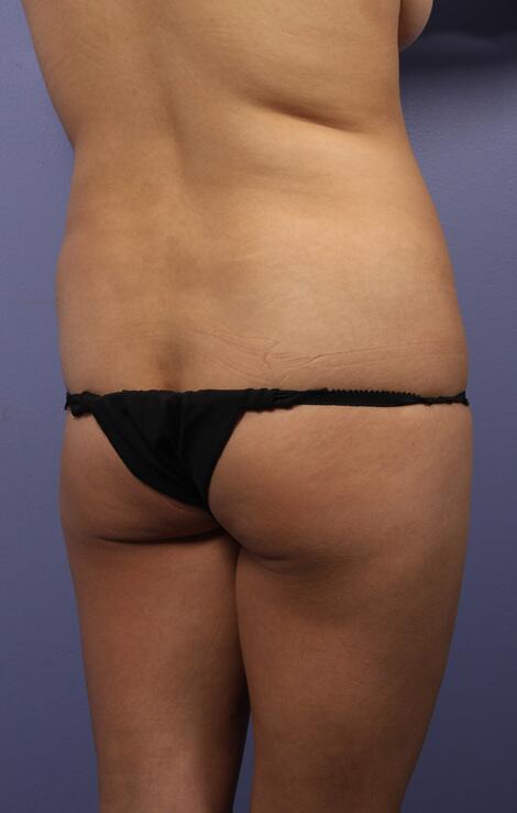 Liposuction Before & After Image