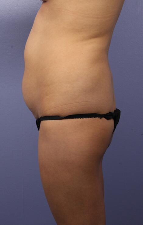 Liposuction Before & After Image