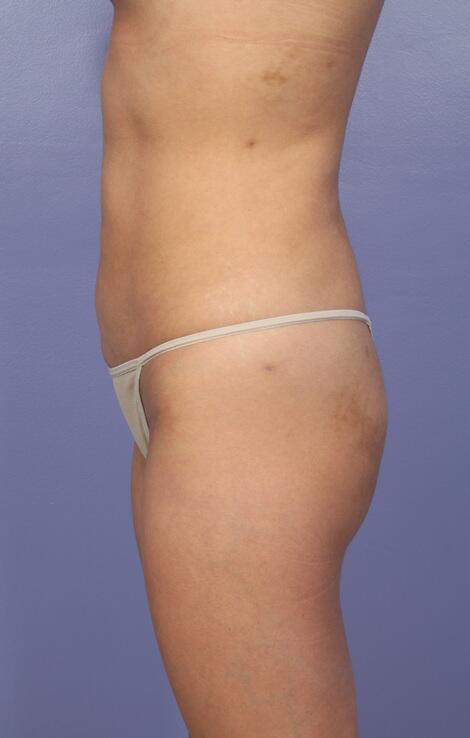 Liposuction Before & After Image