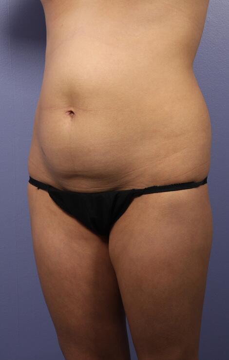 Liposuction Before & After Image