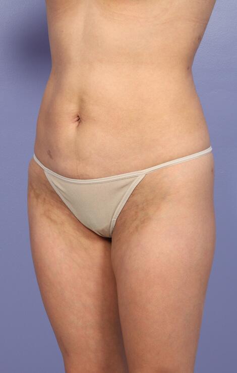 Liposuction Before & After Image