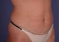 Liposuction Before & After Image