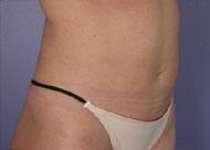 Liposuction Before & After Image