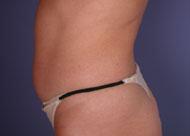 Liposuction Before & After Image