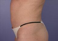 Liposuction Before & After Image