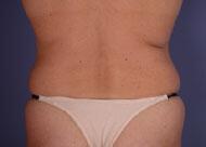 Liposuction Before & After Image